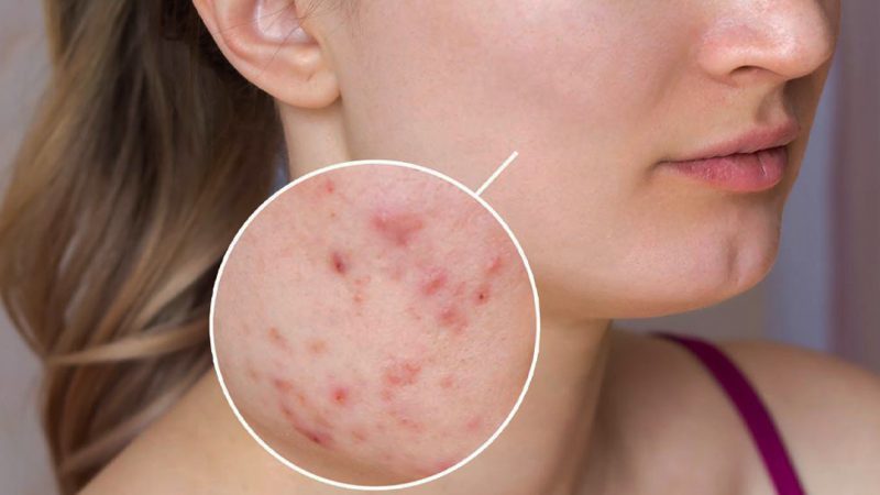 آکنه: آیا با تستسترون تحریک می شود؟
